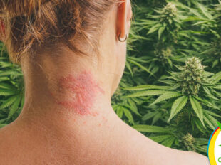 Beneficios del CBD tópico