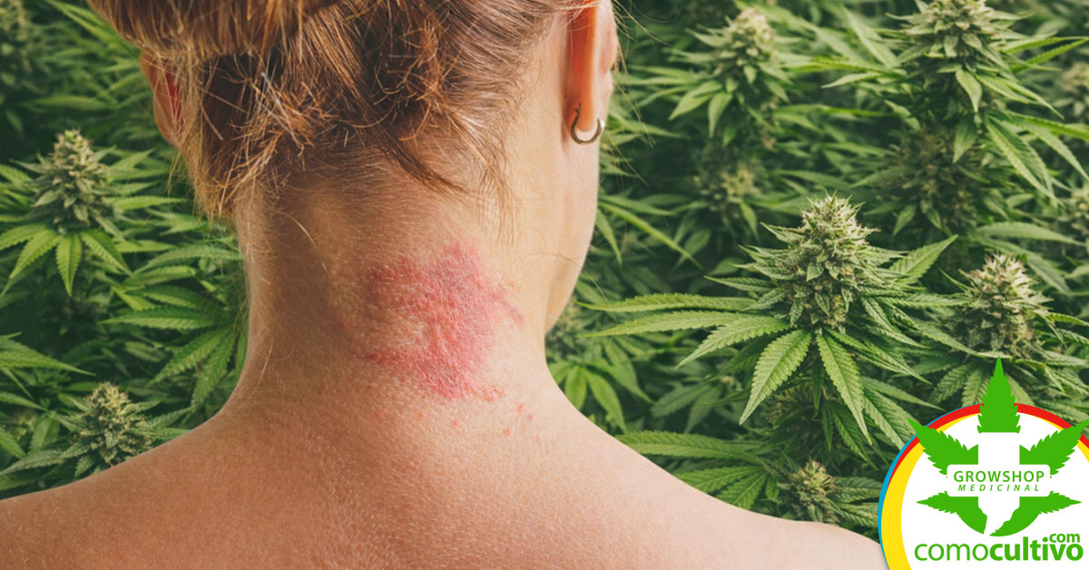 Beneficios del CBD tópico